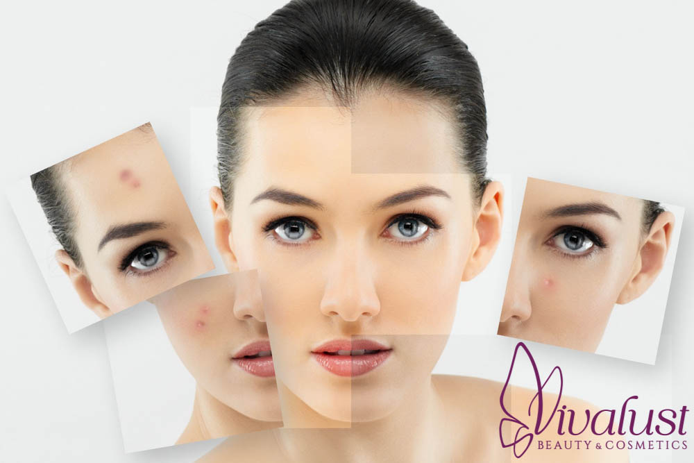 3 Siêu Phẩm Skincare Cho Da Nhiều Mụn Và Thâm Nám