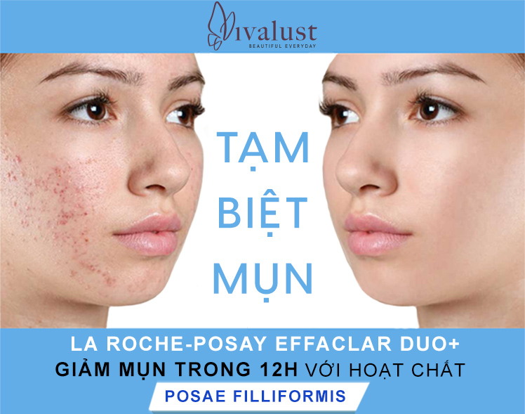 Tạm biệt làn da mụn với kem trị mụn La Roche-Posay Effaclar Duo+