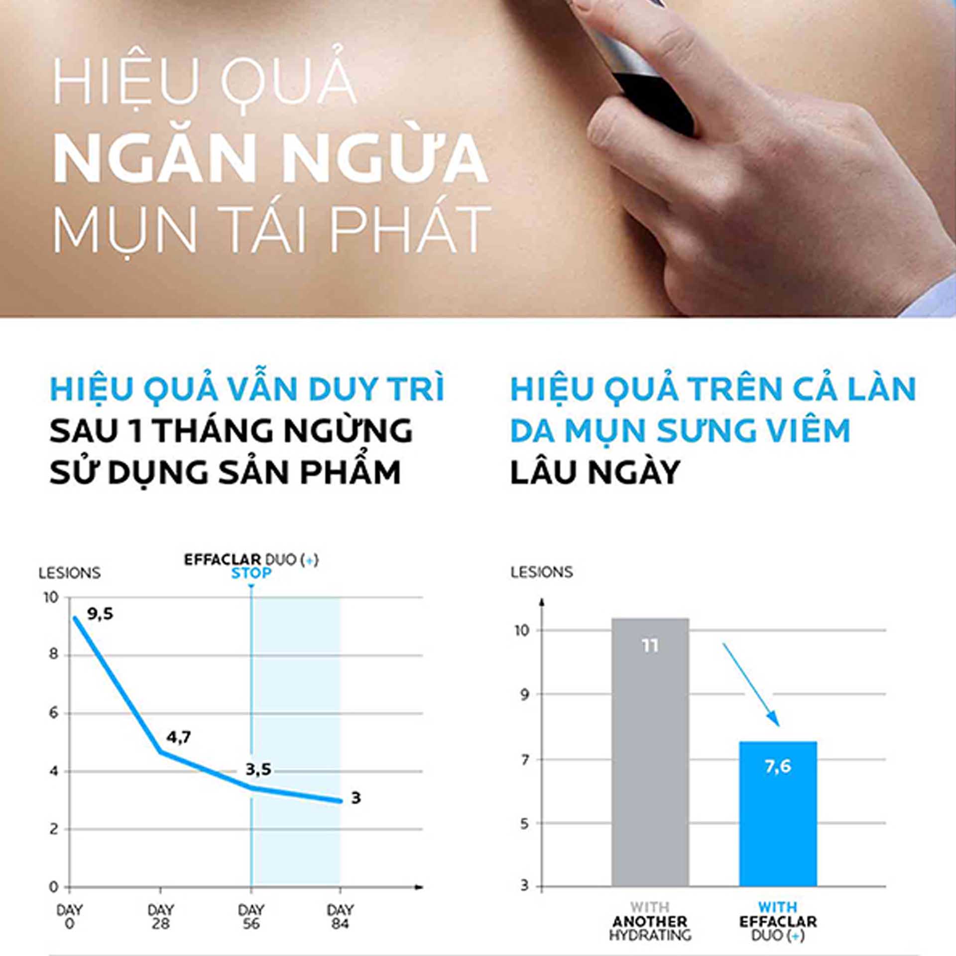 Hiệu quả ngăn ngừa mụn tái phát từ kem giảm mụn La Roche - Posay