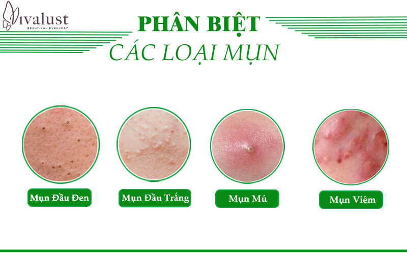 Các loại mụn cần biết