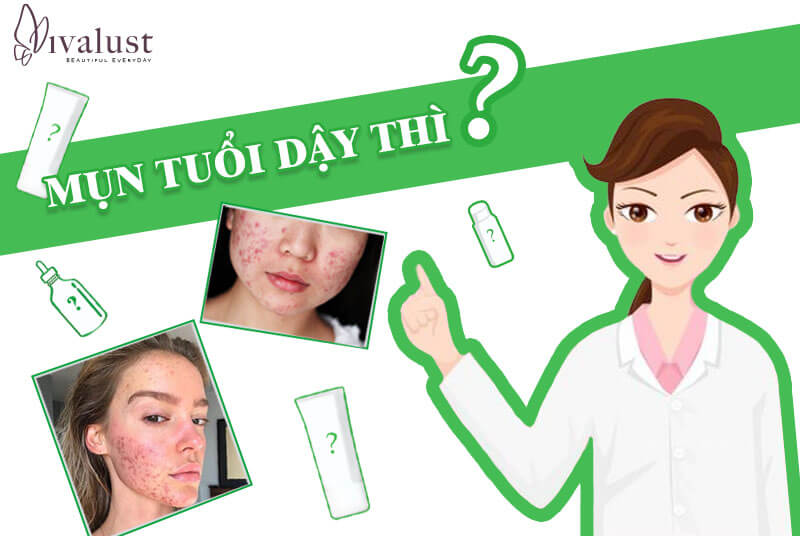Nổi mụn ở tuổi dậy thì