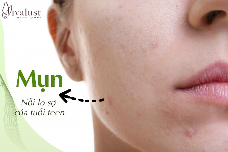 Da dầu và mụn - nỗi ám ảnh của tuổi teen