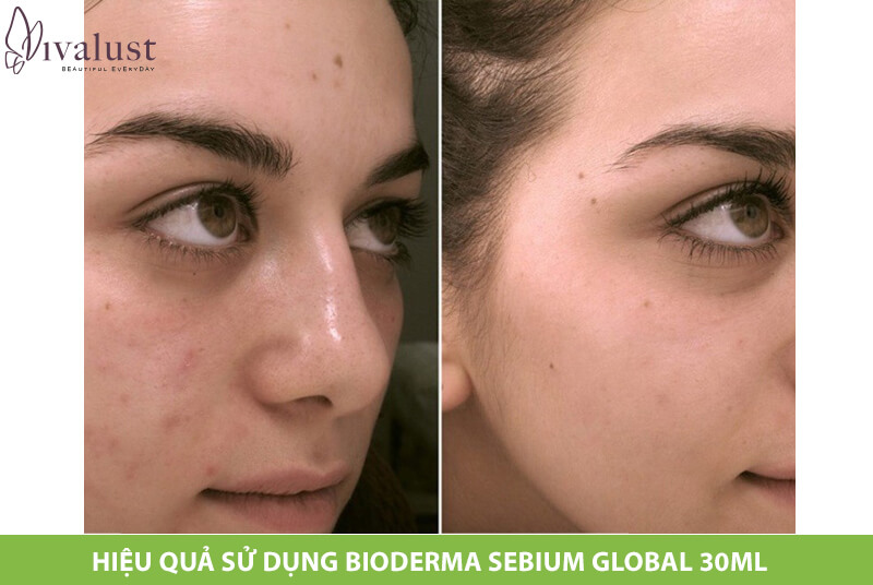 Hiệu quả giảm mụn và vết thâm rõ rệt từ kem dưỡng Bioderma Sebium Global