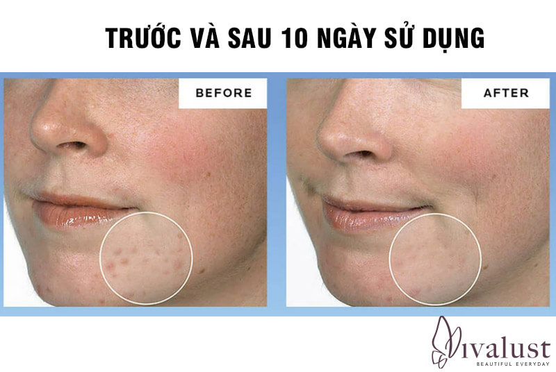 Hiệu quả sau 10 ngày sử dụng kem trị mụn La Roche Posay