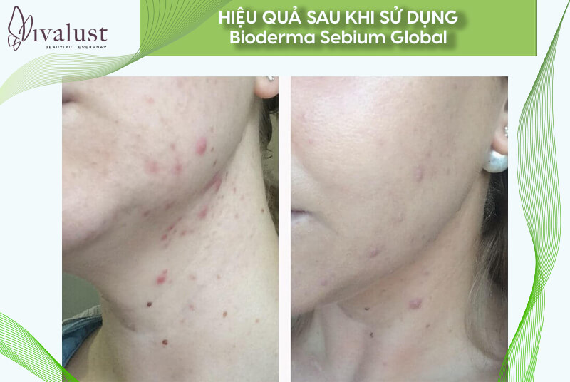 Kem dưỡng Bioderma Global mang lại hiệu quả sau khi sử dụng
