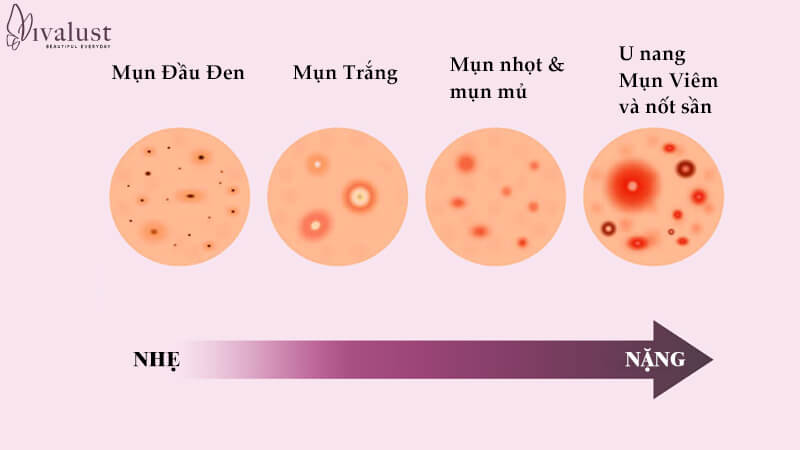 Mụn được chia theo từng cấp độ từ nhẹ đến nặng