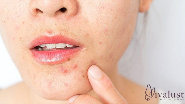 Mụn trứng cá là một tình trạng da khá phổ biến
