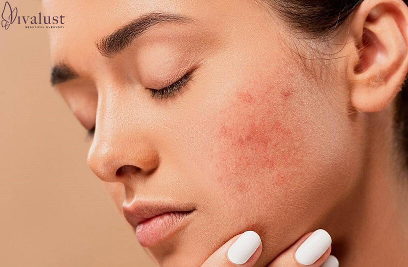 Nguyên nhân gây nên mụn - nỗi ám ảnh của làn da
