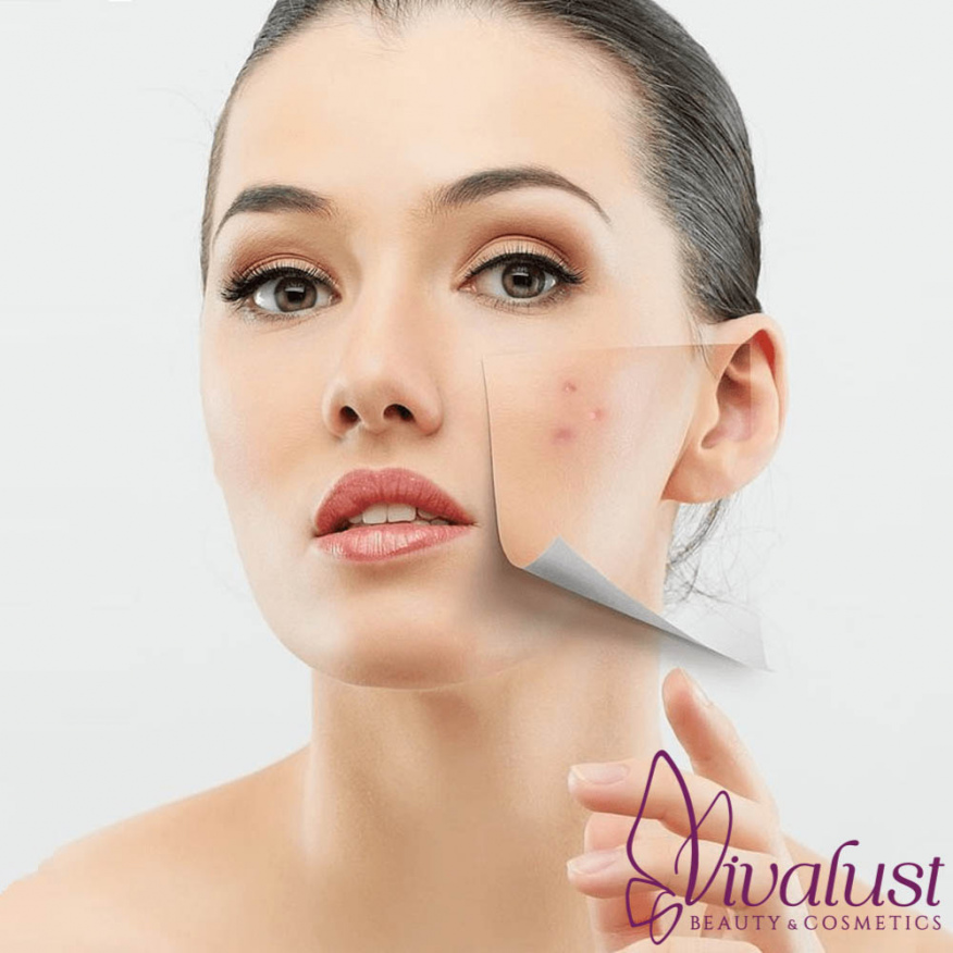 Bí Quyết Trang Điểm Đúng Cách Cho Da Đang Điều Trị Mụn
