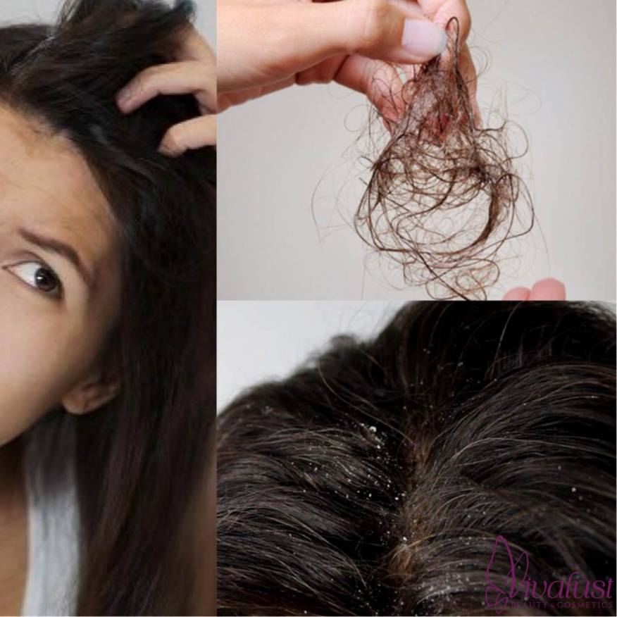 Bạn Cần Làm Gì Khi Da Đầu Ngứa Và Tóc Gãy Rụng?